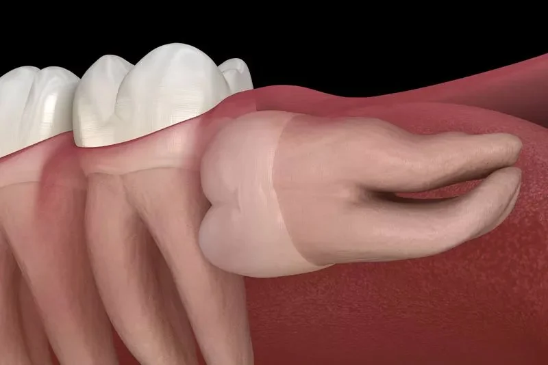impacted wisdom tooth model 2