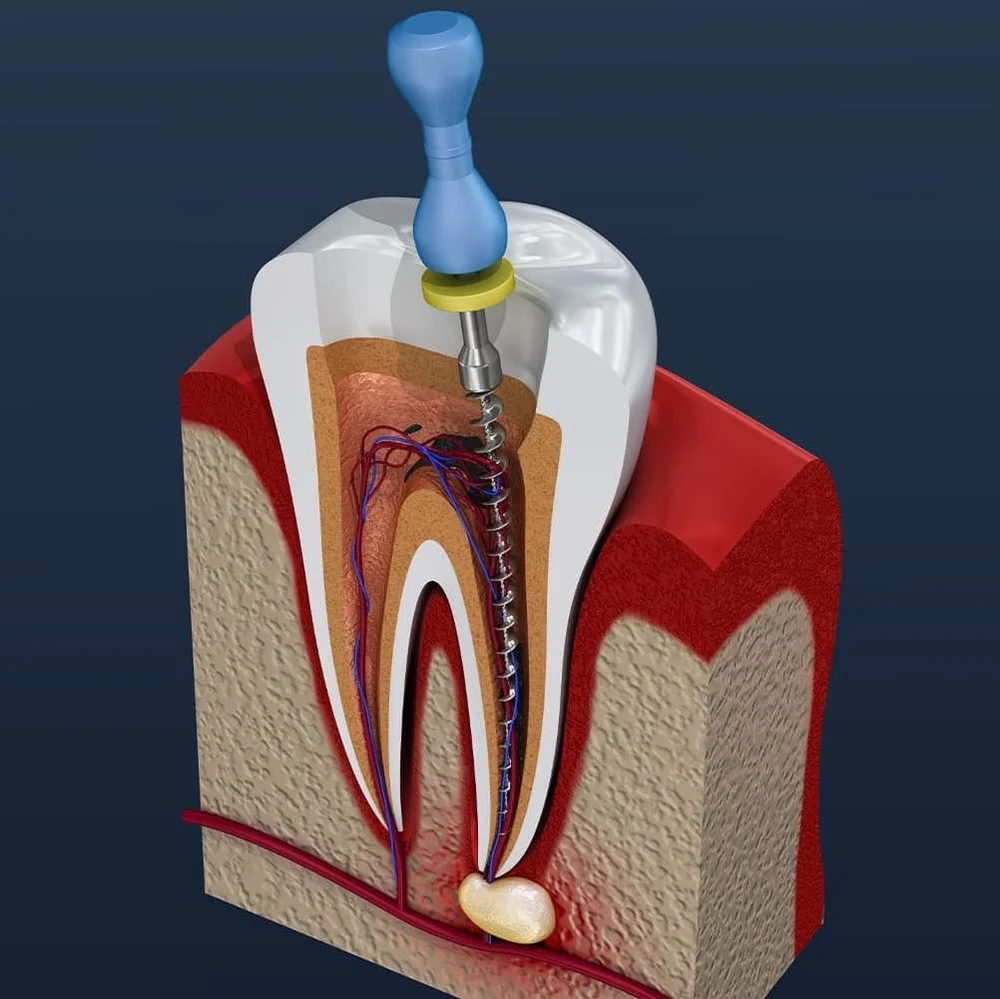 root canal treatment